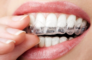 Férula de descarga + revisión dental
